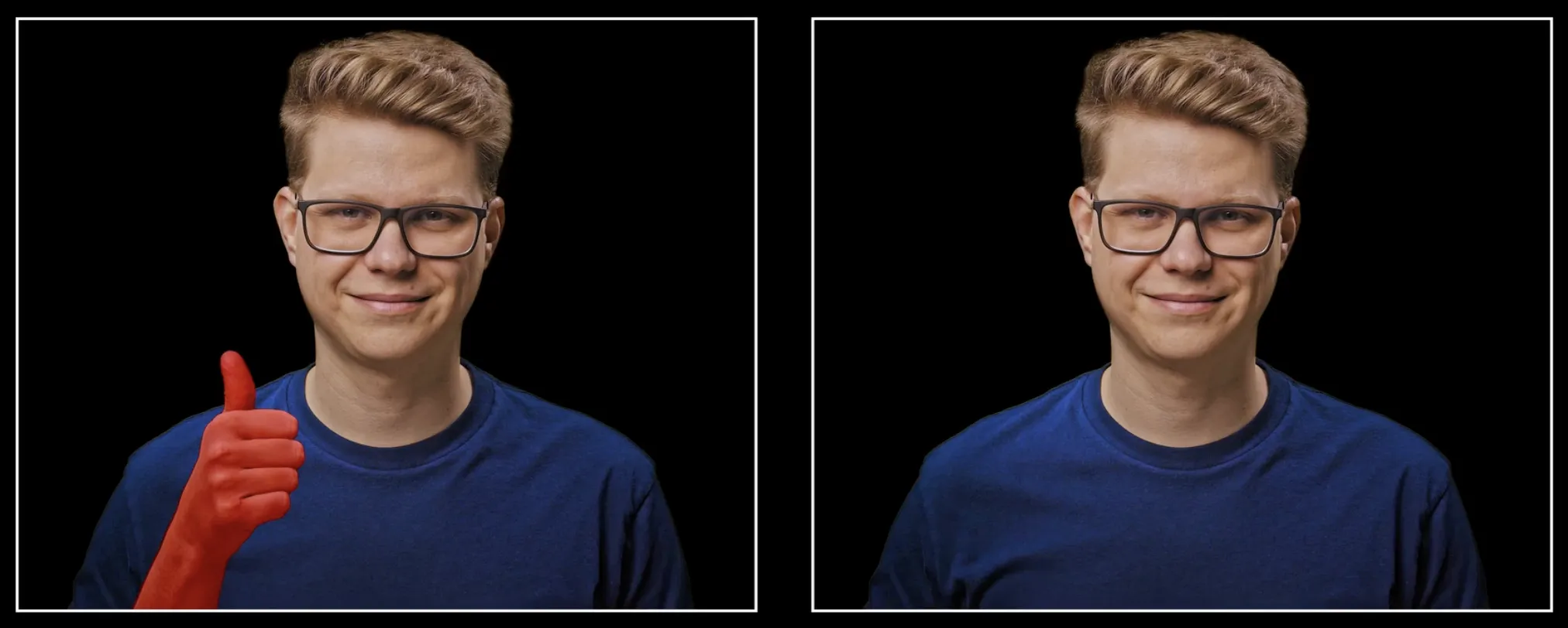 Duas fotos lado a lado do Filipe: na esquerda, com um braço fazendo joinha pintado de vermelho destacando a remoção; na direita, sem o braço